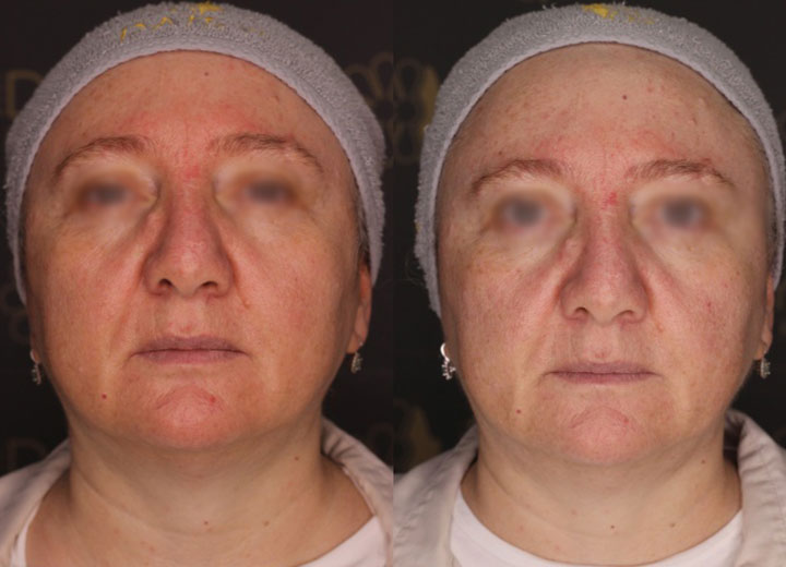 before-after