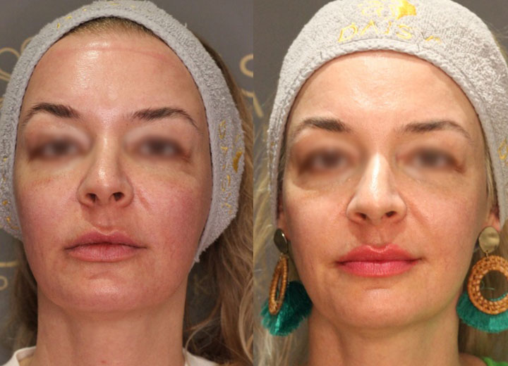 before-after