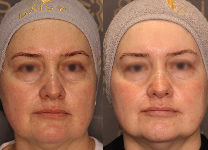 before-after