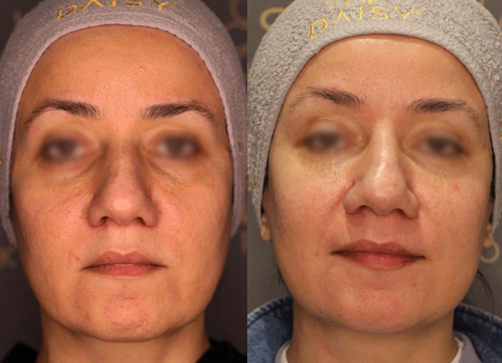 before-after