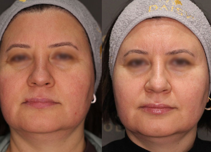 before-after
