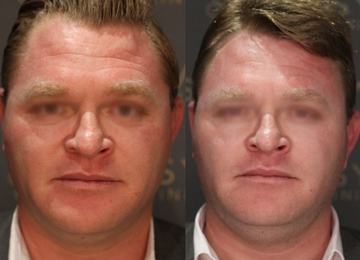 before-after