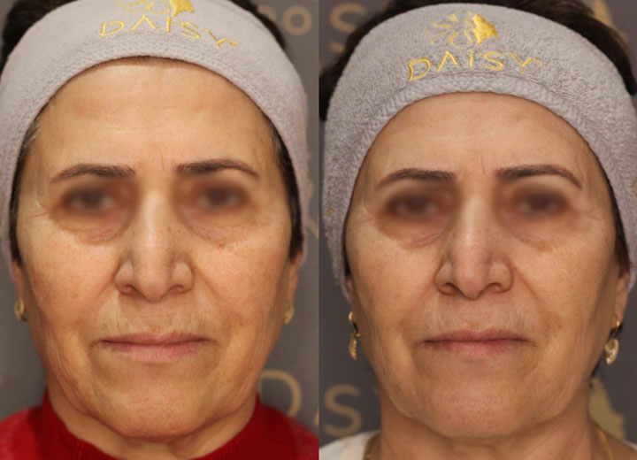 before-after