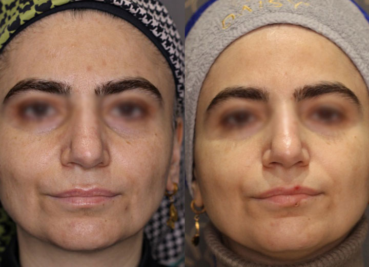 before-after