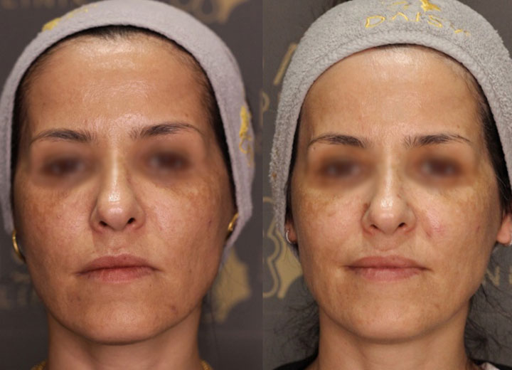 before-after