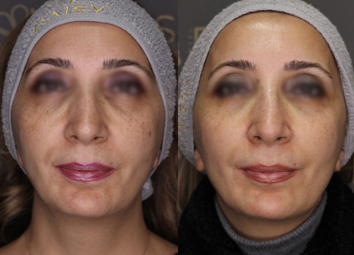 before-after